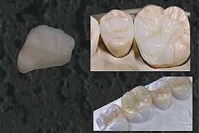 Etching Liquid inlay onlay purpose