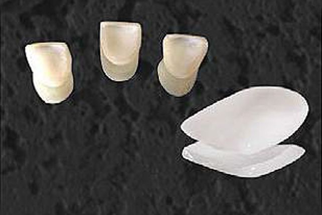 Etching Liquid veneer crown purpose