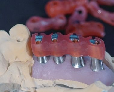 JIG-GEL final implant jig