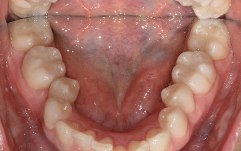 Zircos-Com Flow after clinical result