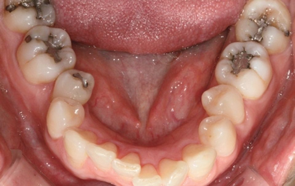 Zircos-Com Flow before clinical result