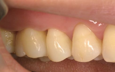 Zircos-Com Hard after restoration