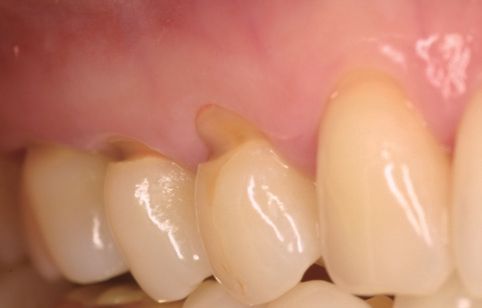 Zircos-Com Hard before restoration